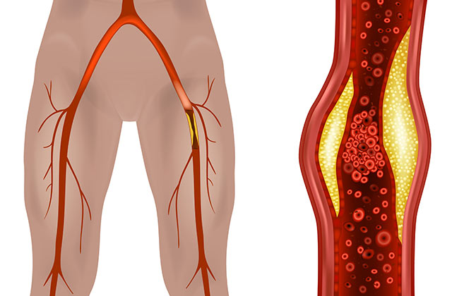 third river health conditions pvd pad clogged artery